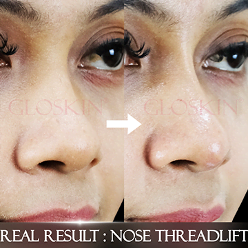 Nose Threadlift