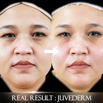 Face Contour Juvederm / Chroma