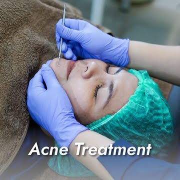Acne Treatment